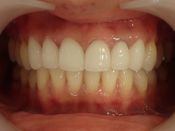 after cosmetic dentistry