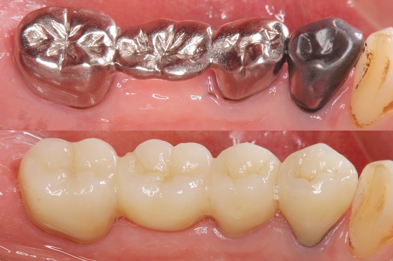 What are the advantages of ceramics over metal restorations like silver crowns?