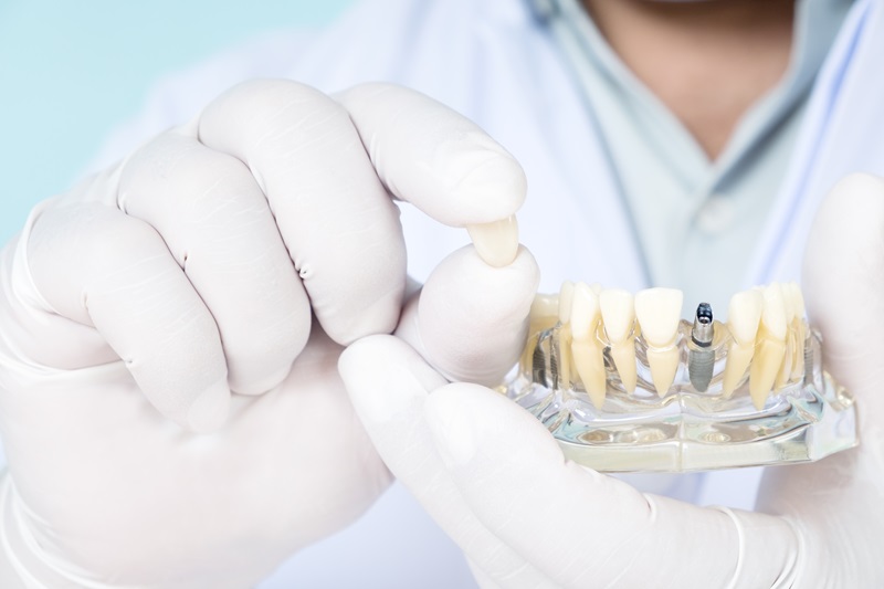 The Difference in Duration Between Implant Treatments and Other Treatments for Replacing Missing Teeth