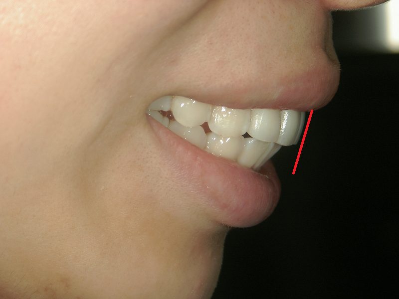 After Protruding Teeth (or Buck Teeth) Treatment