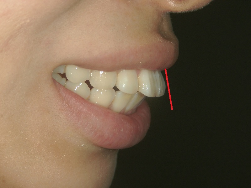 Before Protruding Teeth (or Buck Teeth) Treatment