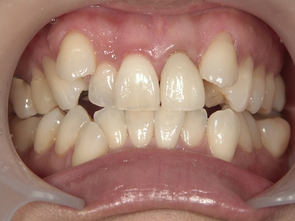 Before Case Photos of Crowded (crooked) Teeth Treatment