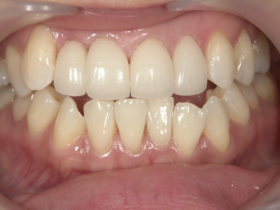 After Case Photos of Crowded (crooked) Teeth Treatment