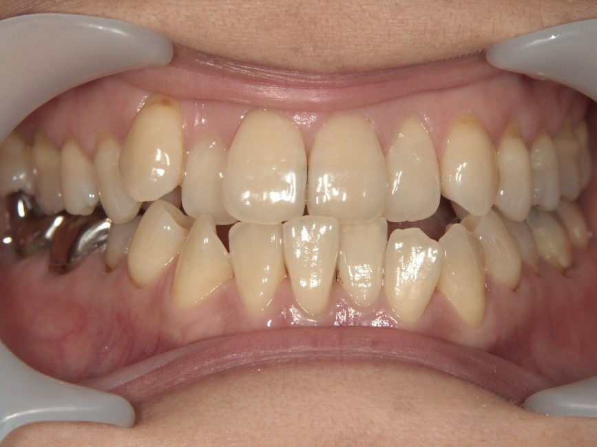 Before Case Photos of Crowded (crooked) Teeth Treatment