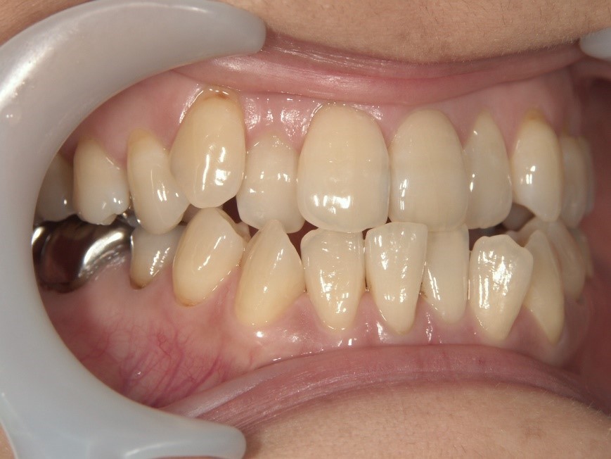 Before Case Photos of Crowded (crooked) Teeth Treatment