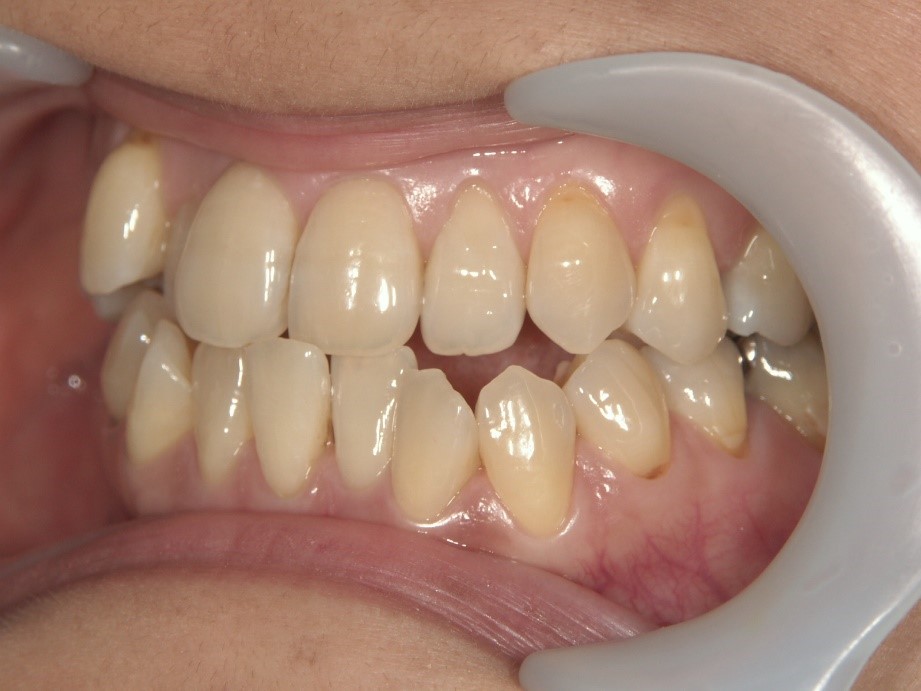 Before Case Photos of Crowded (crooked) Teeth Treatment