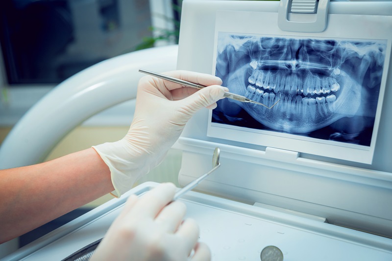 Five Key Points to Make Dental Implants Last Longer