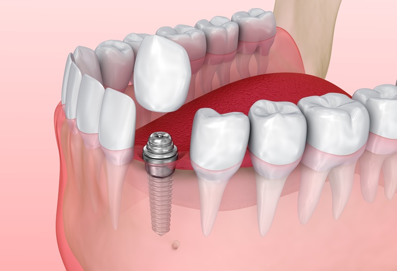 Causes of Dental Implant Problems