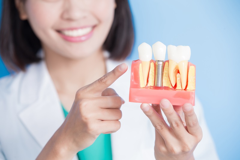 What is a Dental Implant?