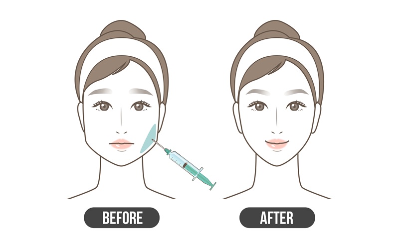 Masseter Botox (Jawline Botox):