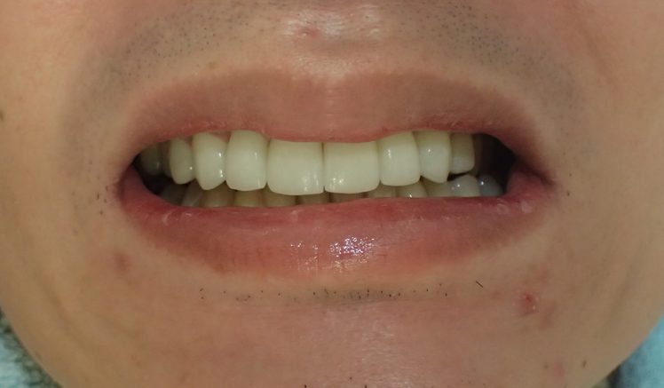 After Before Treatment for Making Teeth More Visible When Smiling (Reverse Gummy Smile)