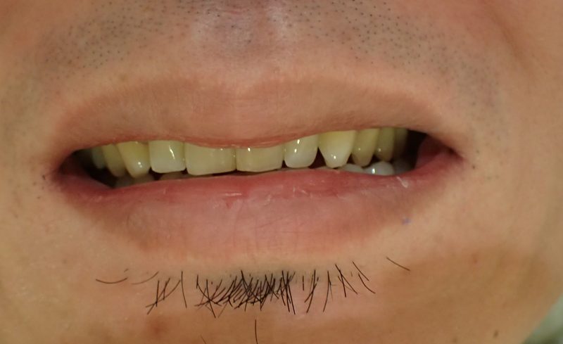 Before Treatment for Making Teeth More Visible When Smiling (Reverse Gummy Smile)