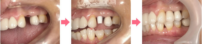 Implant Treatment