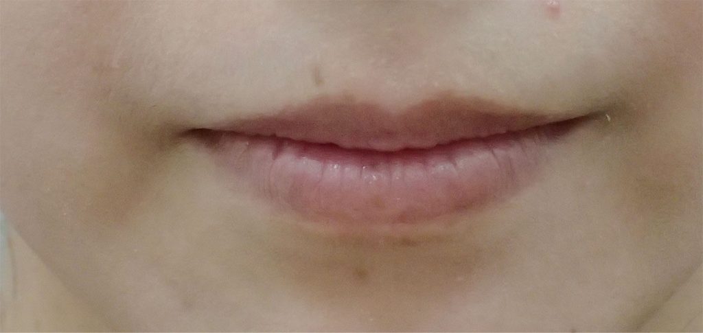 Before Hyaluronic Acid Lip Treatment