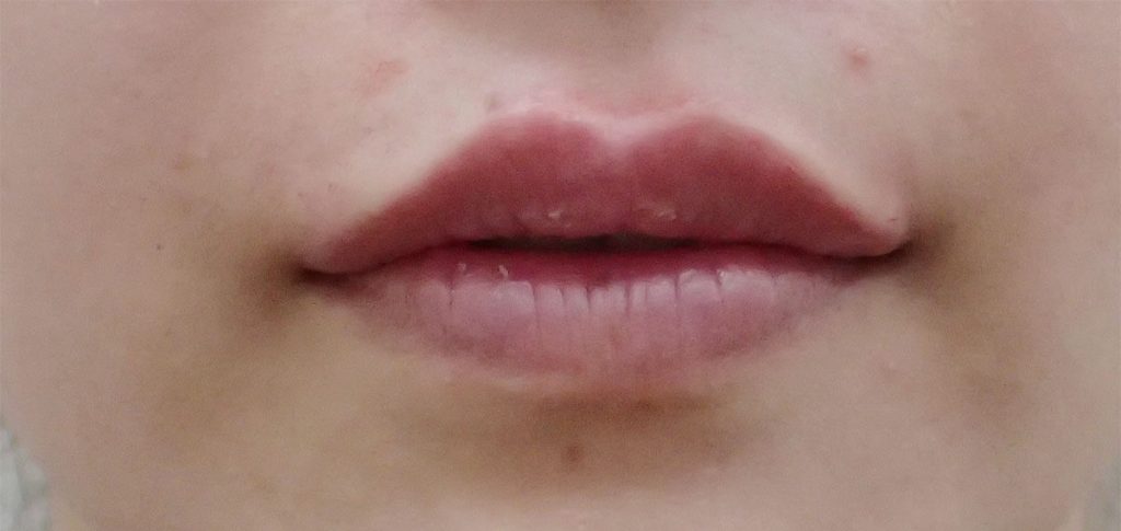 After Before Hyaluronic Acid Lip Treatment