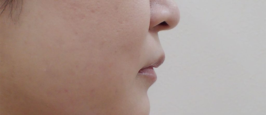 Before Hyaluronic Acid Lip Treatment