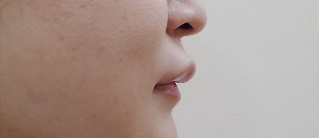 After Before Hyaluronic Acid Lip Treatment