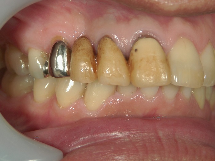 Before Replacement of Crowns and Silver Fillings