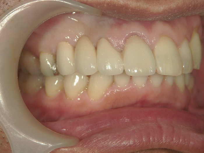 After Before Replacement of Crowns and Silver Fillings