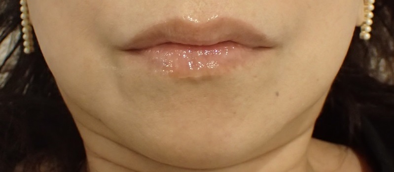 After Botox＋Hyaluronic Acid Lip Treatment