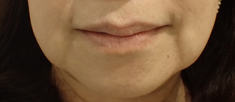 Before Botox＋Hyaluronic Acid Lip Treatment