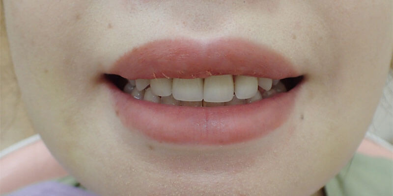 After Upper Lip Mucosal Resection