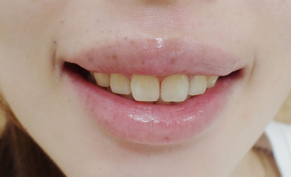 After Upper Lip Mucosal Resection